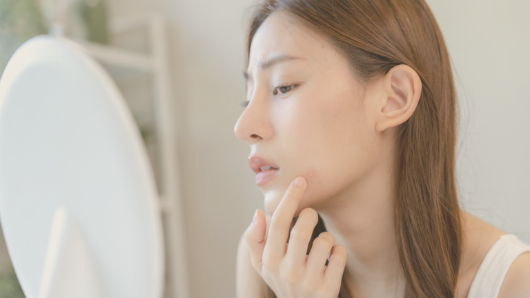 Acne: uma condição médica que vai além da estética — causas, graus e tratamentos modernos