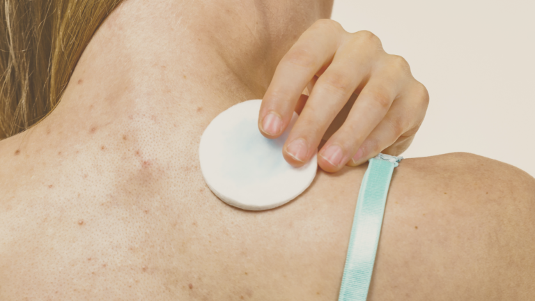 Acne: por que o acompanhamento com um nutrólogo pode fazer toda a diferença no tratamento?