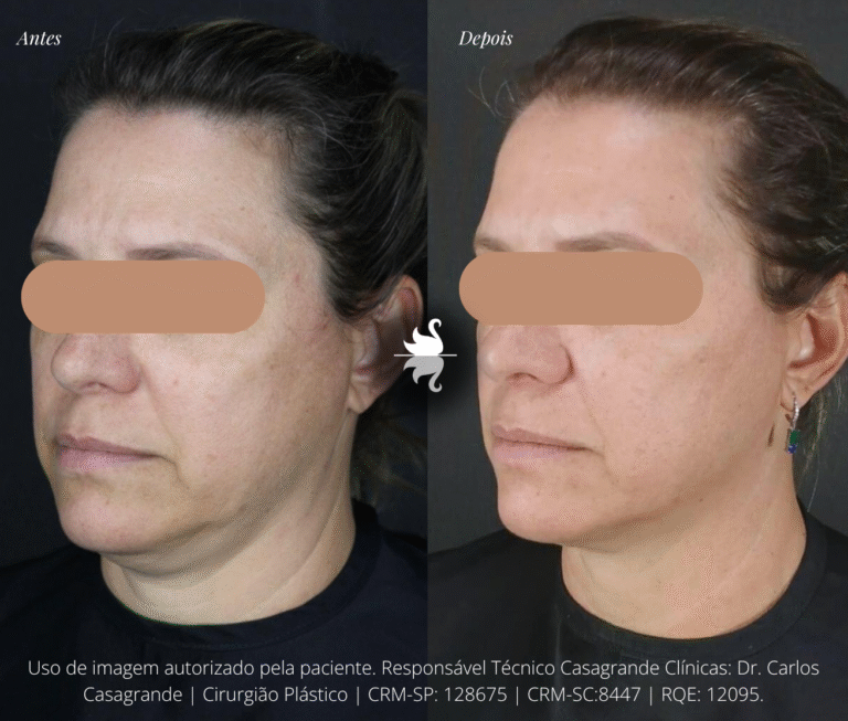 Antes e Depois de Morpheus CRM-SP: 128675 | CRM-SC: 8447 RQE: 12094 | RQE: 12095