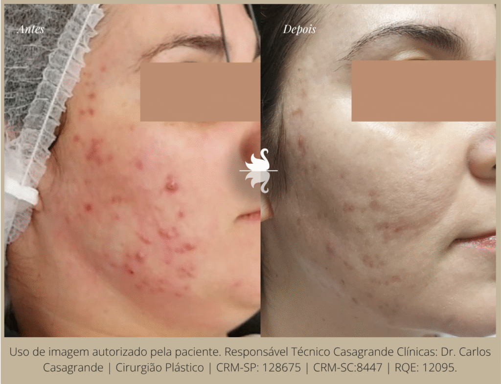 Antes e Depois de Fotona para Acne CRM-SP: 128675 | CRM-SC: 8447 RQE: 12094 | RQE: 12095