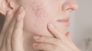 Acne da mulher adulta: como o laser Fotona pode transformar sua pele