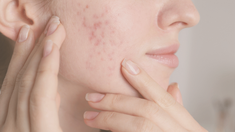 Acne da mulher adulta: como o laser Fotona pode transformar sua pele