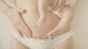 O Mommy Makeover é um conjunto de procedimentos estéticos e cirúrgicos que ajuda mulheres a recuperar o corpo e a autoestima após a gestação. Descubra como funciona, quais técnicas podem ser utilizadas e como é o pós-operatório.