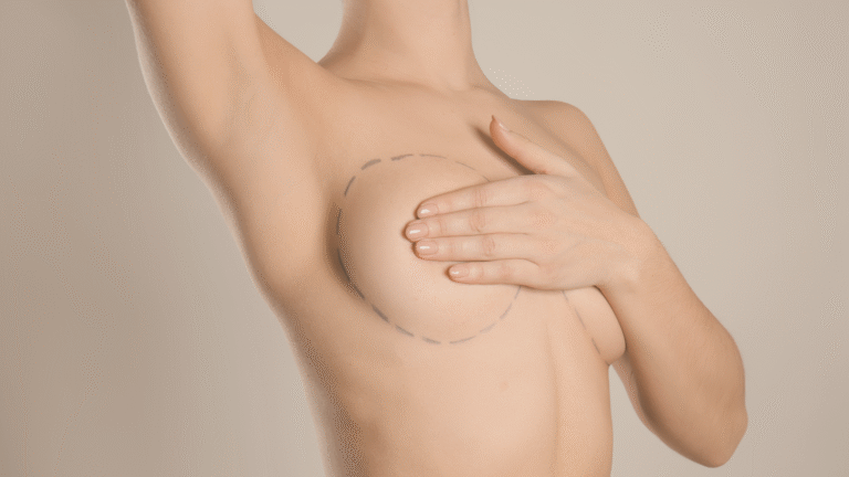 Implantes Mamários: tudo o que você precisa saber antes da cirurgia
