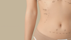 Elimine a gordurinha localizada com LipoTight sem cortes