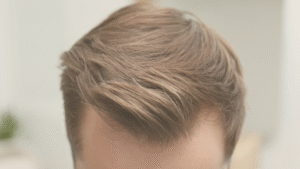 Transplante Capilar FUE: como garantir um resultado natural e harmônico