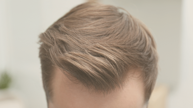 Transplante Capilar FUE: como garantir um resultado natural e harmônico