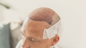 Cuidados após o Transplante Capilar FUE: guia completo para uma recuperação segura